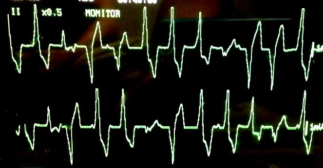 ECG badness (Michel Doney)