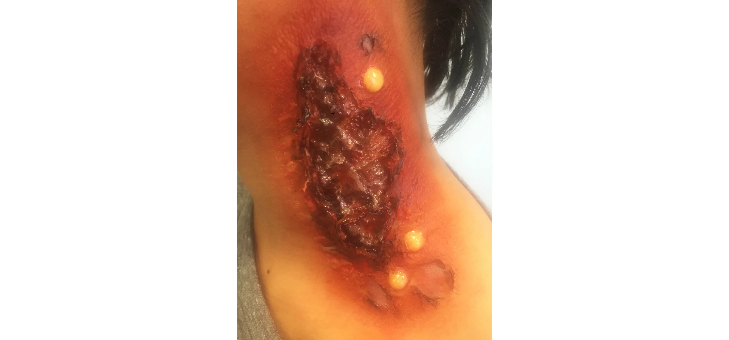 Third degree burn made with latex and 3rd Degree Silicone