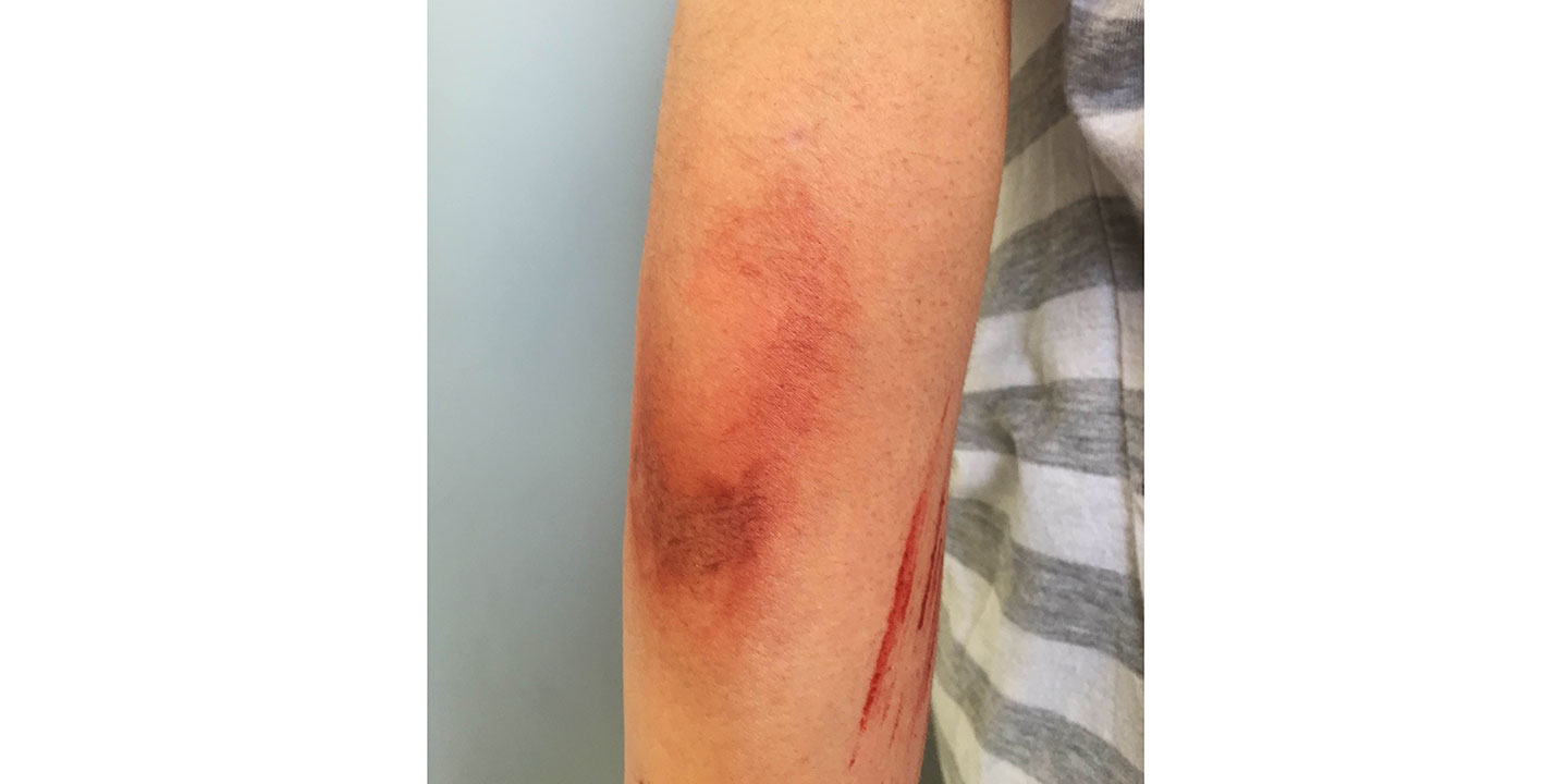 Bruise