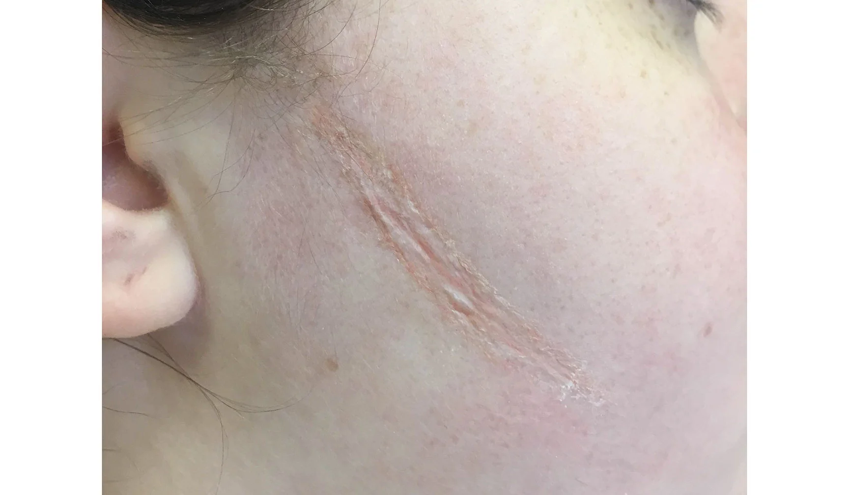 Recessed Scar
