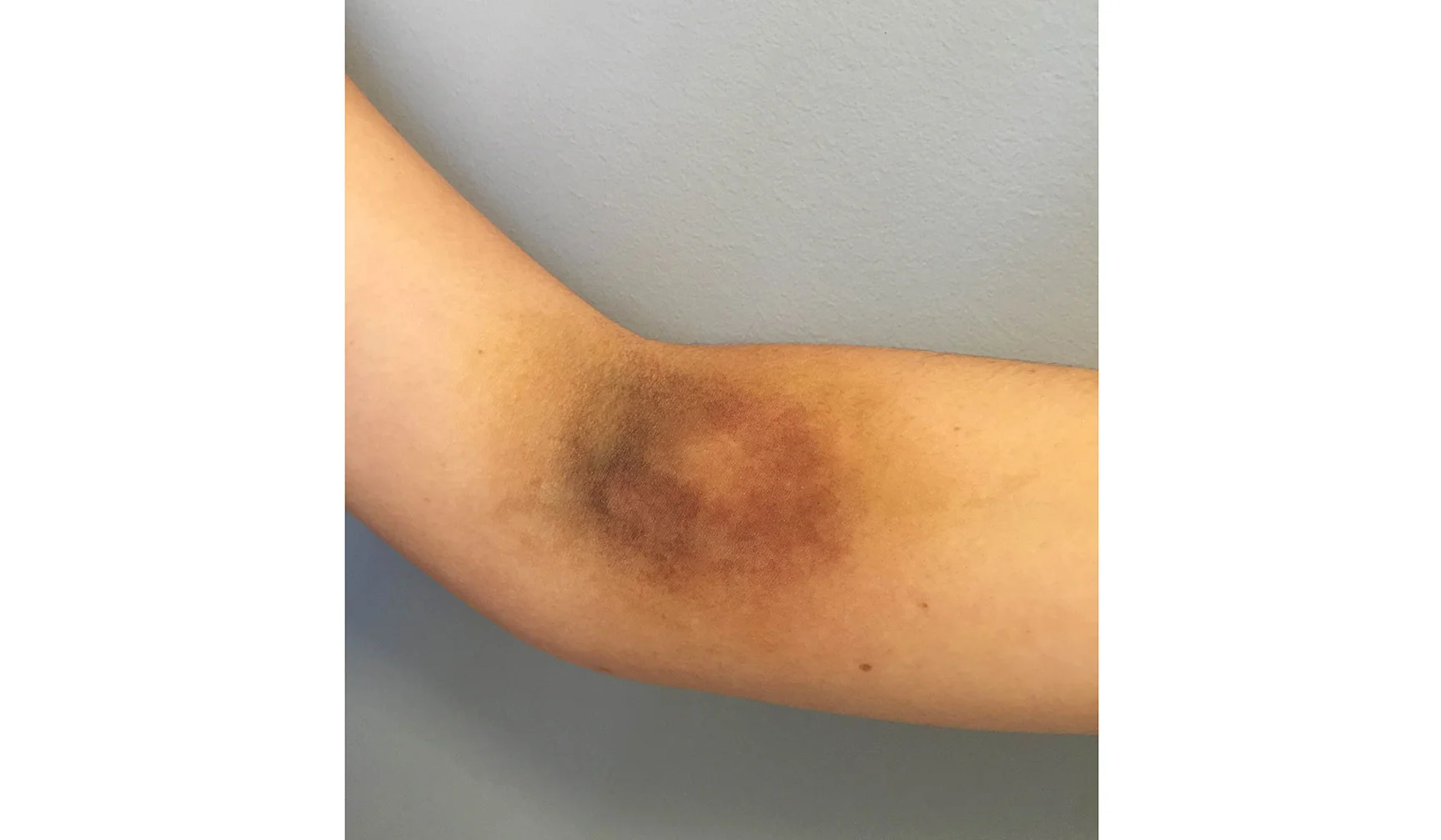 Old Bruise