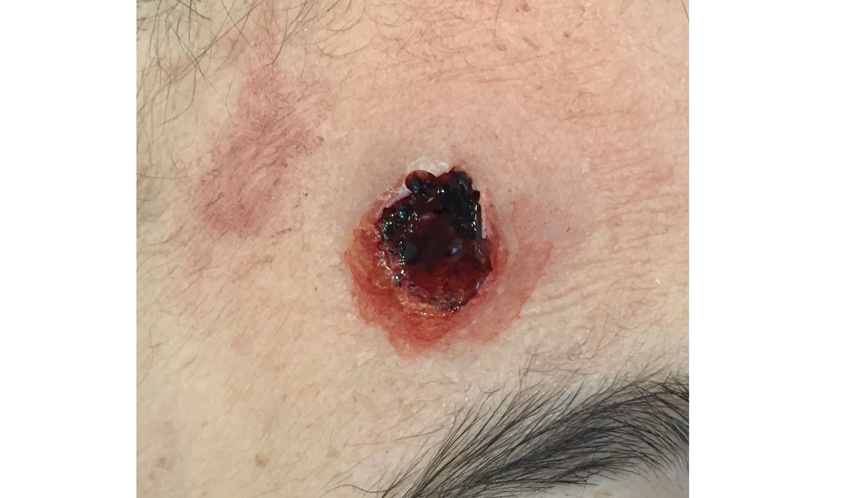 Gelatin prosthetic bullet hole