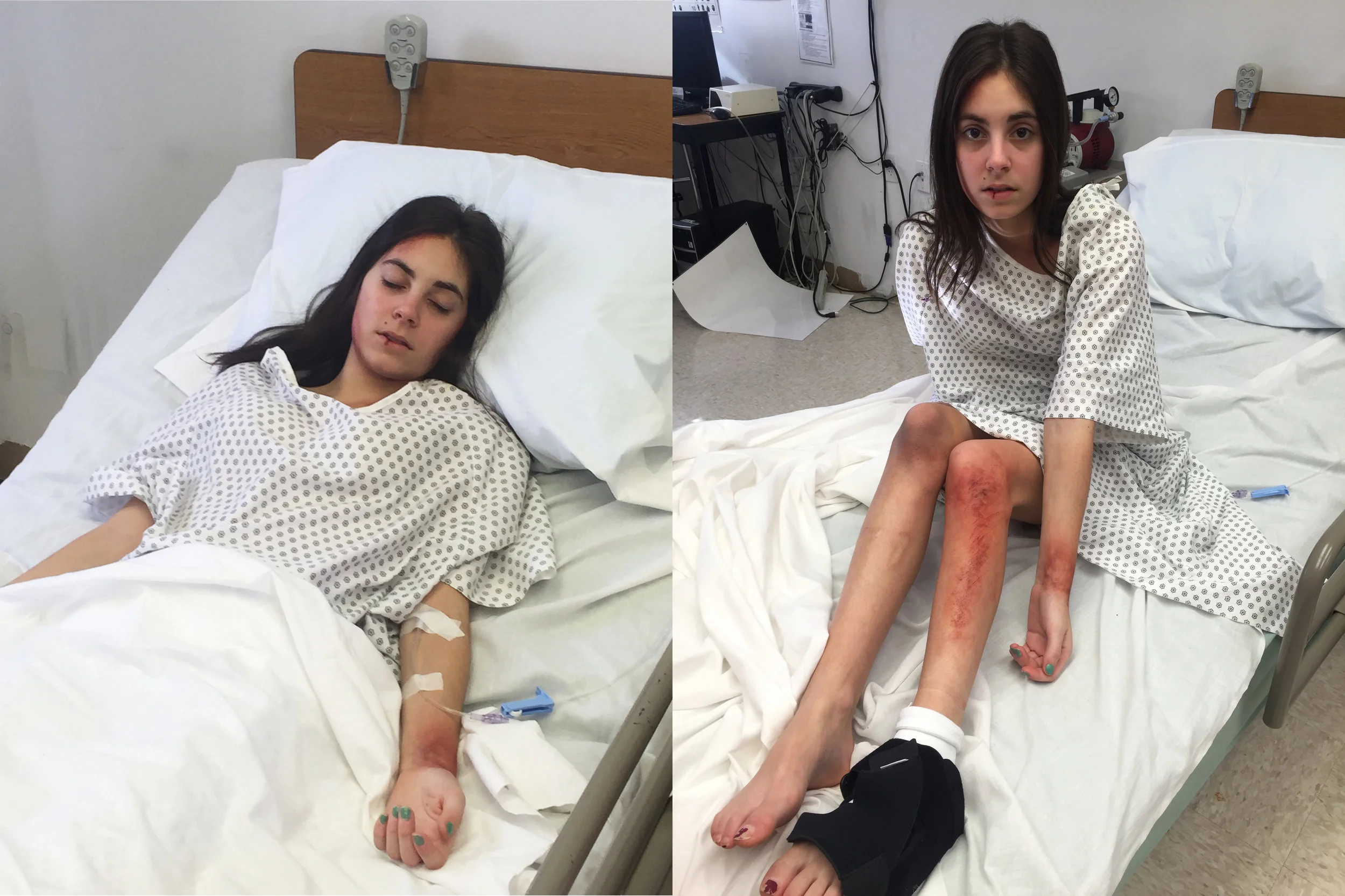 Alcohol color injuries on actress Kristen Vaganos for the short film Mira , written and directed by Natasha Babenko
