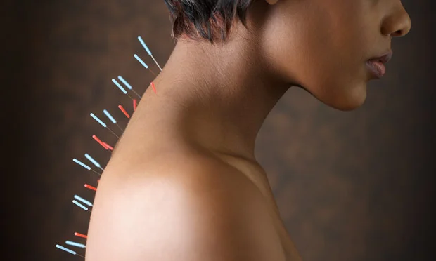 Acupuncture-needles-in-a--011.jpg
