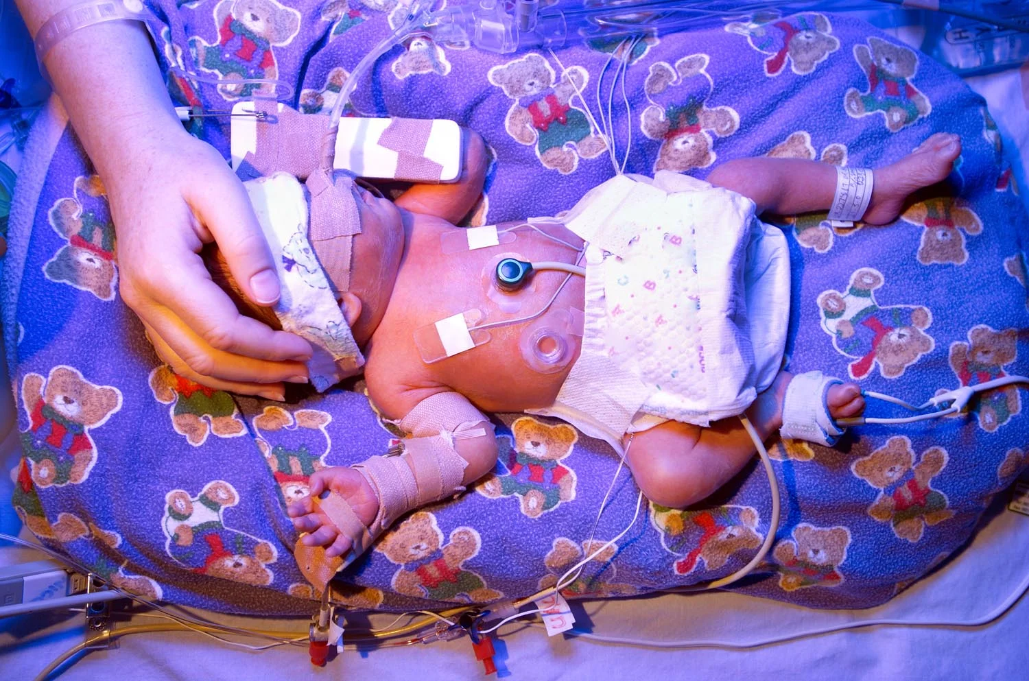 nicu micropreemie with IV phototherapy, mothers hand on head