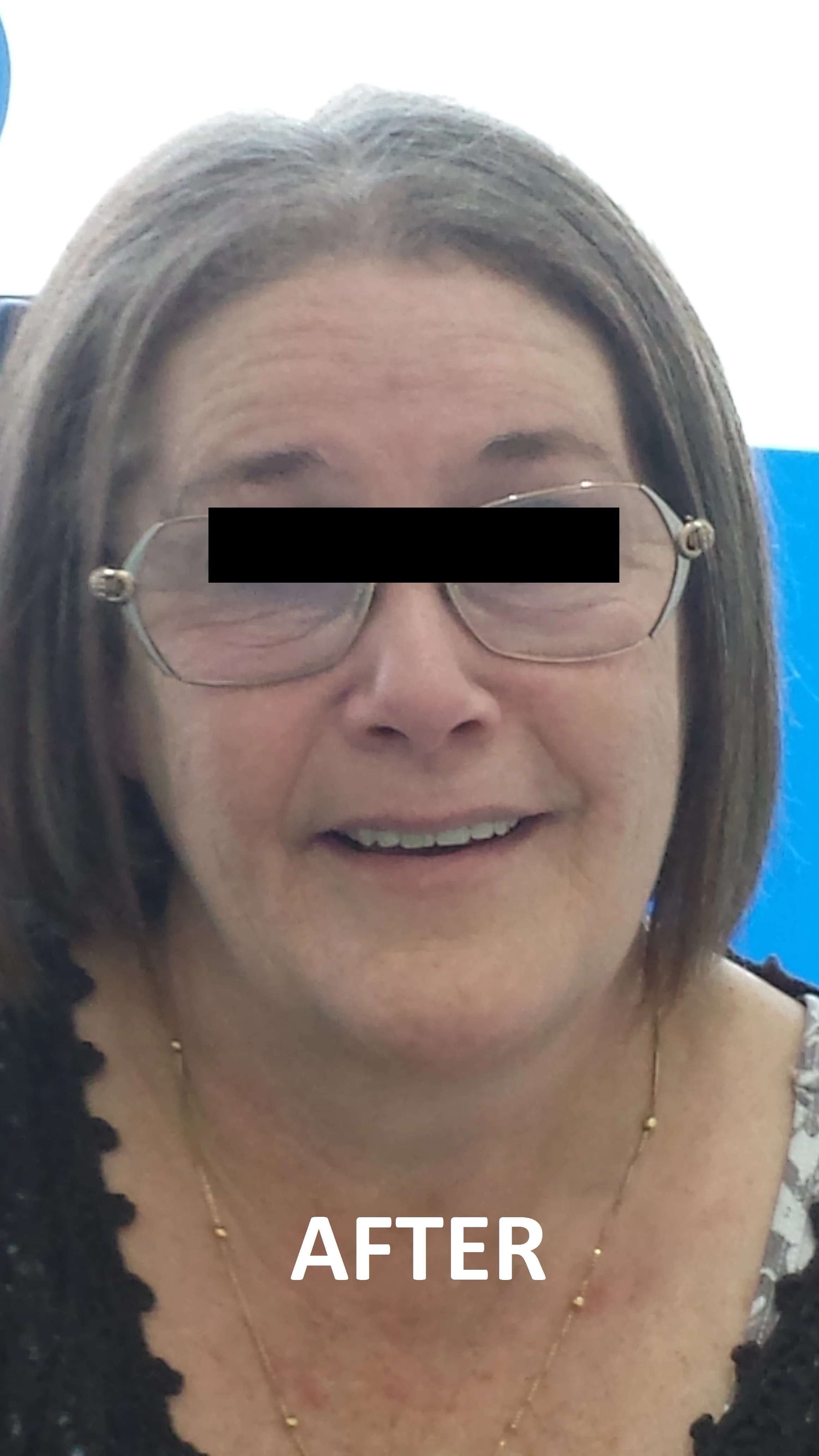 Full Denture.jpg
