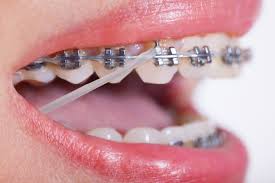 rubber bands braces.jpeg