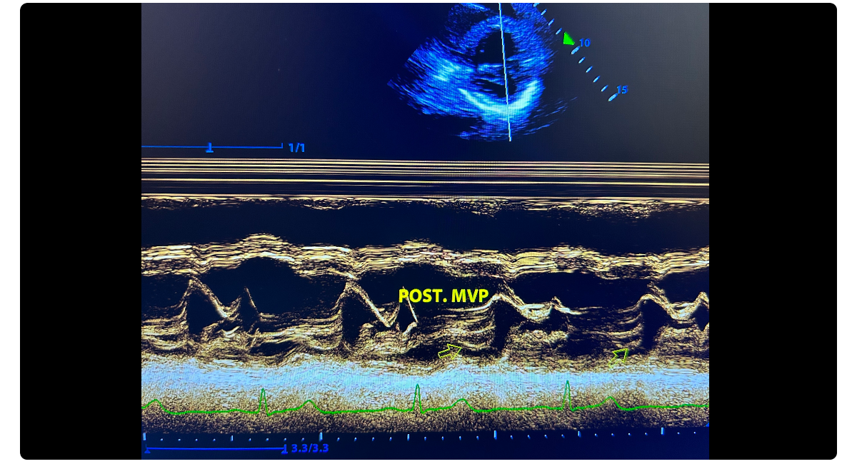 Adult Echo - Miltral Valve Prolapse