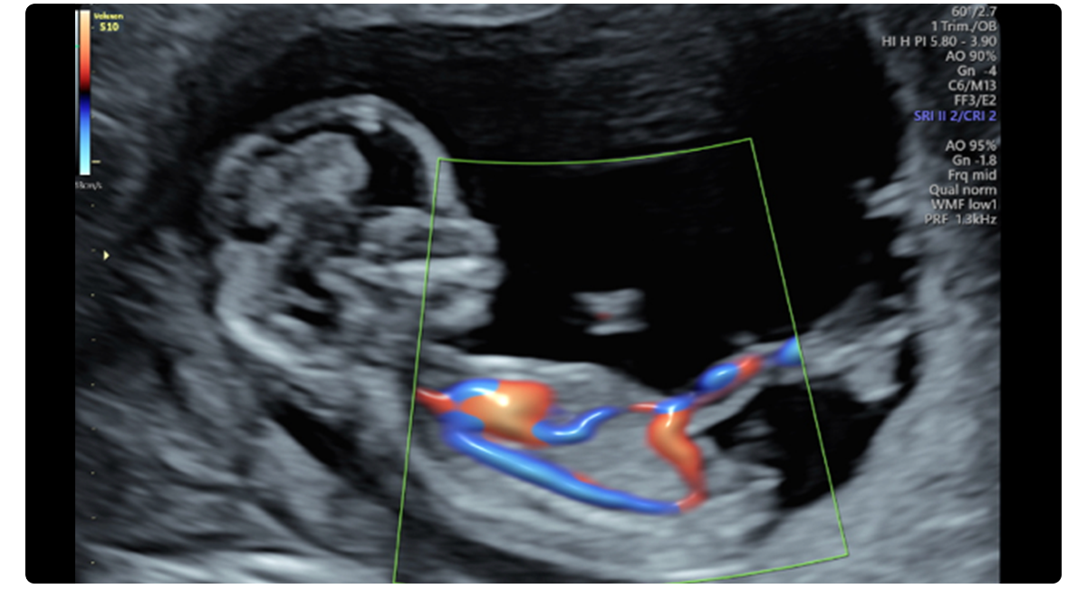 Fetal Circulation