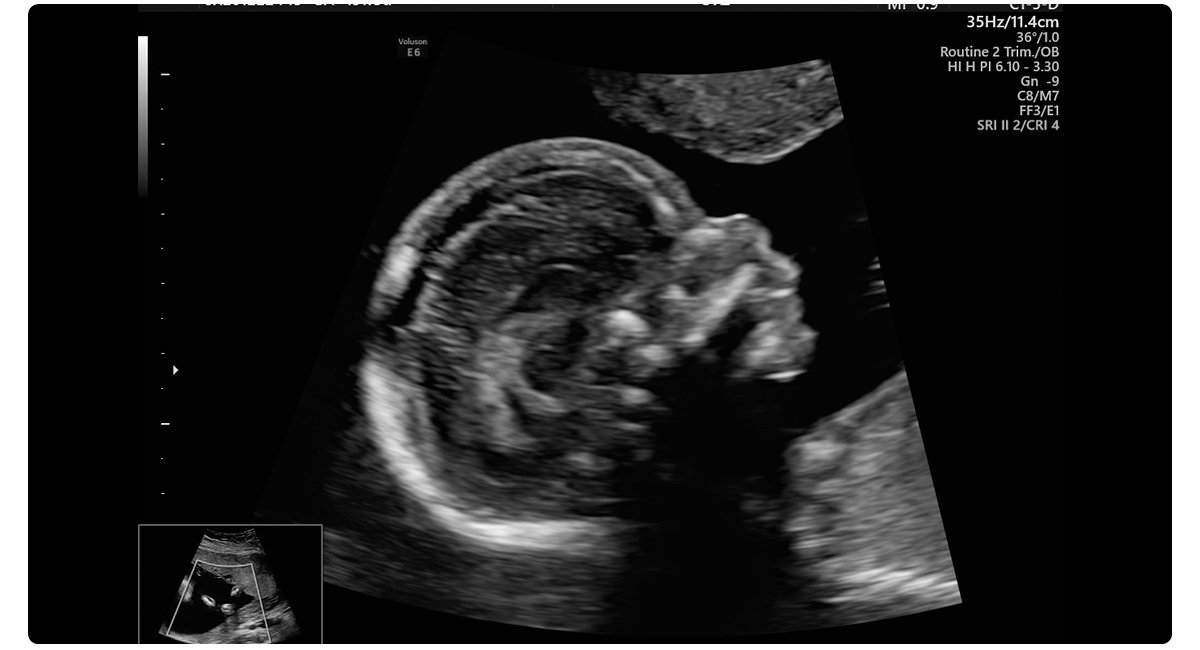 Fetal Profile 