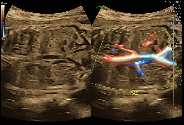Diaphragmatic hernia, 29 weeks