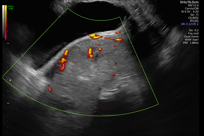 Potential Placenta Accreta, 32 weeks