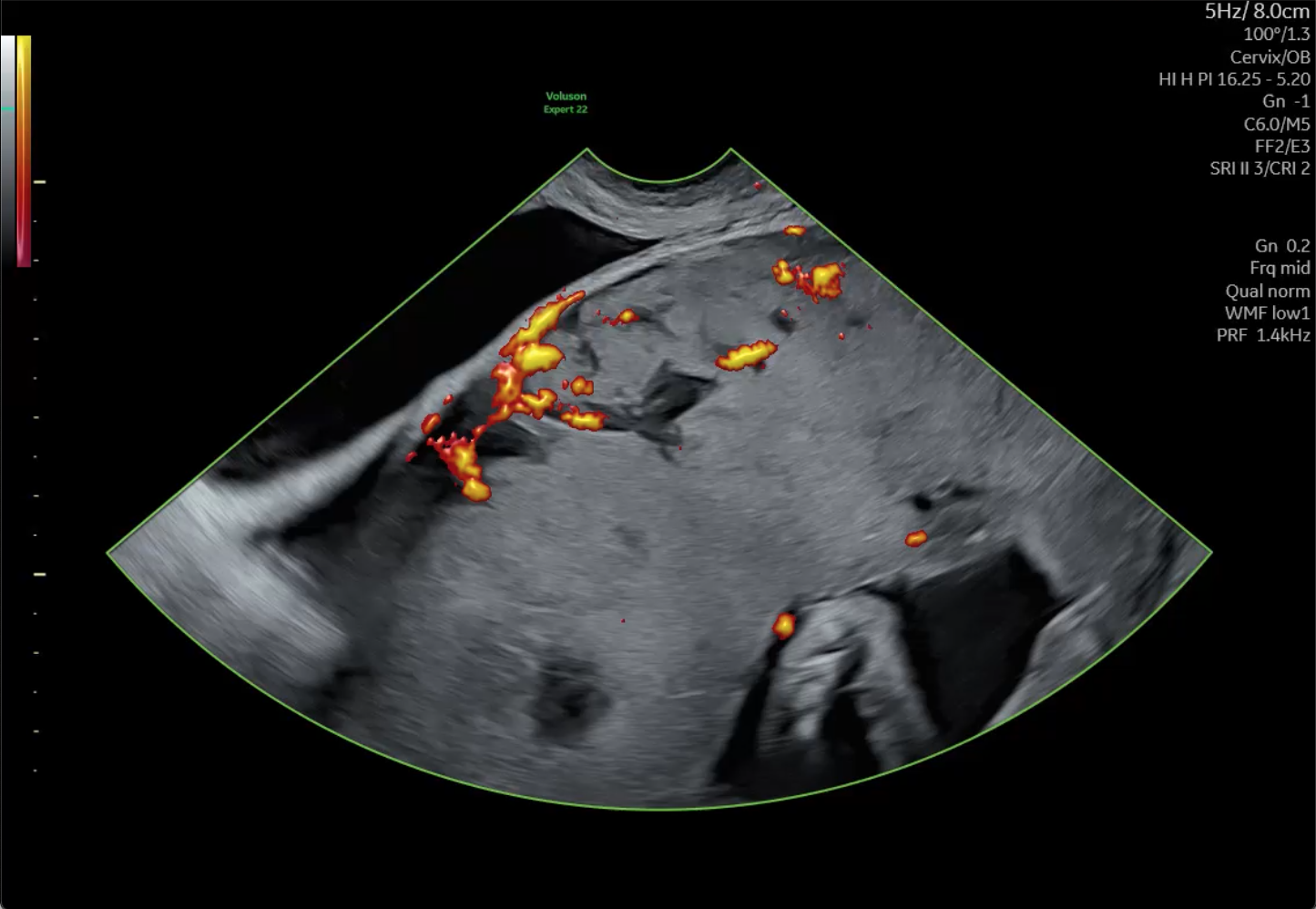 Potential Placenta Accreta, 34 weeks