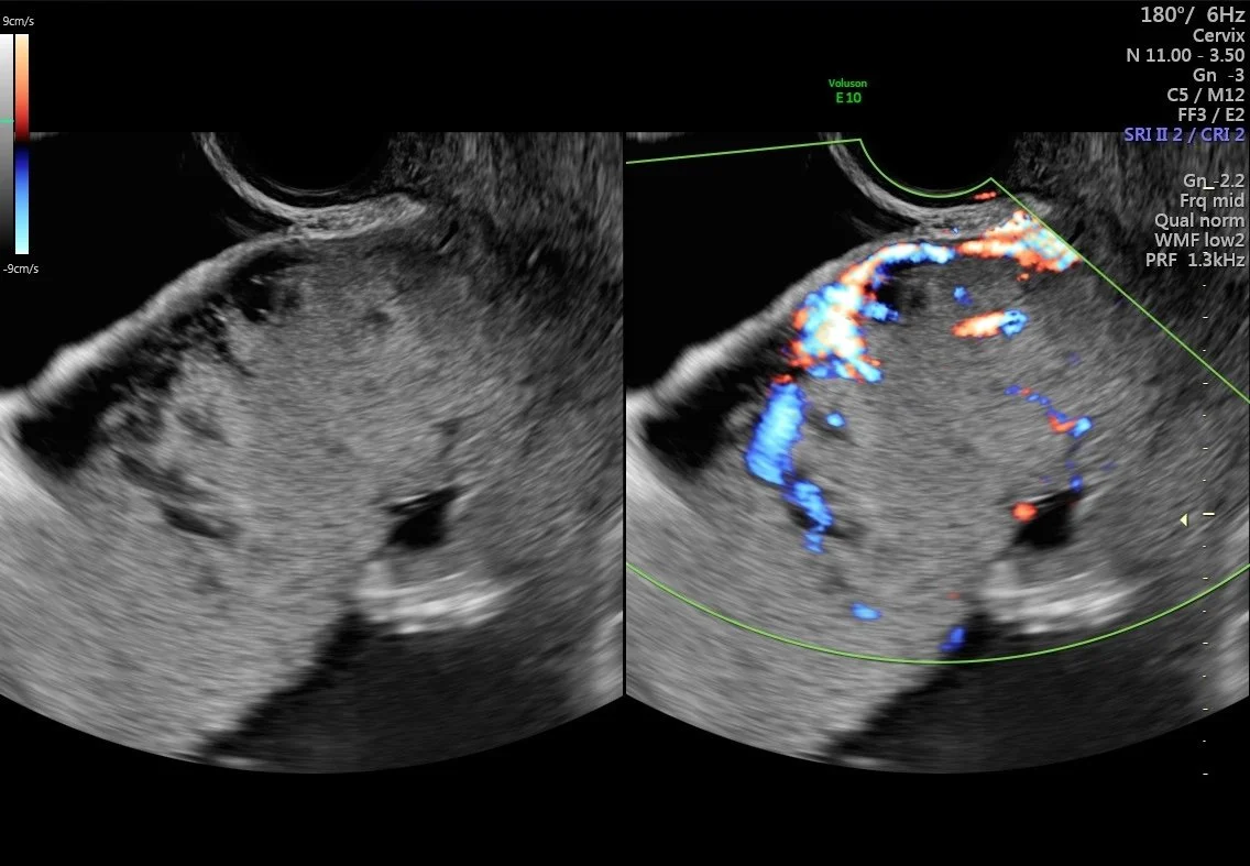 Potential Placenta Accreta, 28 weeks