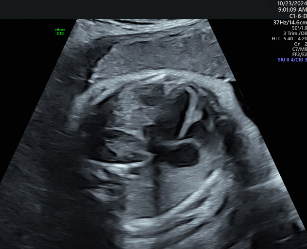 Diaphragmatic hernia