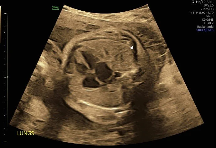 Diaphragmatic hernia, 29 weeks