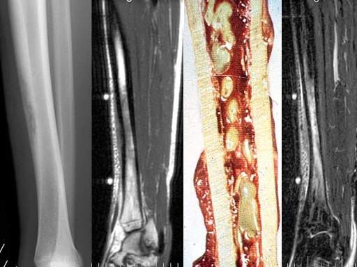 Osteomielites Prof. Dra. Ana Lúcia L.M. Lima