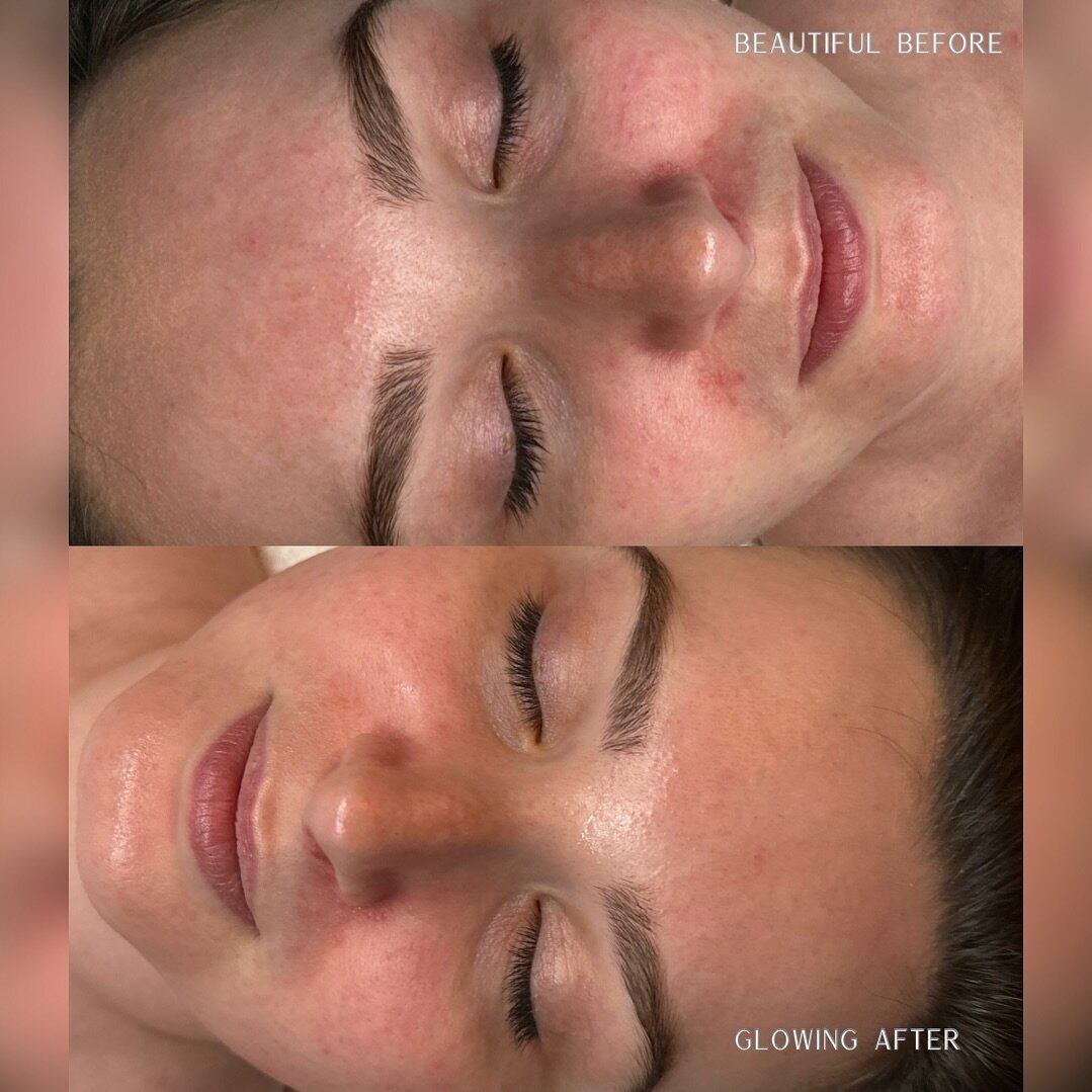 ✨ Magic Mask ✨
🔔 New Service Alert! 🔔 

The difference an hour can make! 
My beautiful model doesn&rsquo;t even have moisturizer on yet in the &lsquo;after&rsquo; photo. 

Notice how much it calmed her rosacea, evened out her coloring, plumped the 