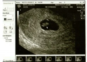 One Picture-The Story of Our First Miscarriage