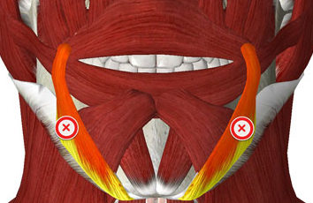 Botox injection points for sad mouth corners and Marionette lines
