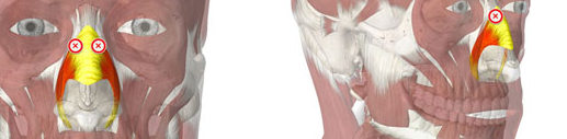 Botox for bunny lines on the nose