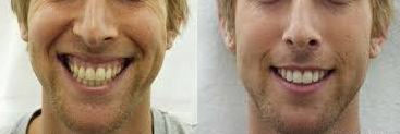 BEFORE AND AFTER GUMMY SMILE