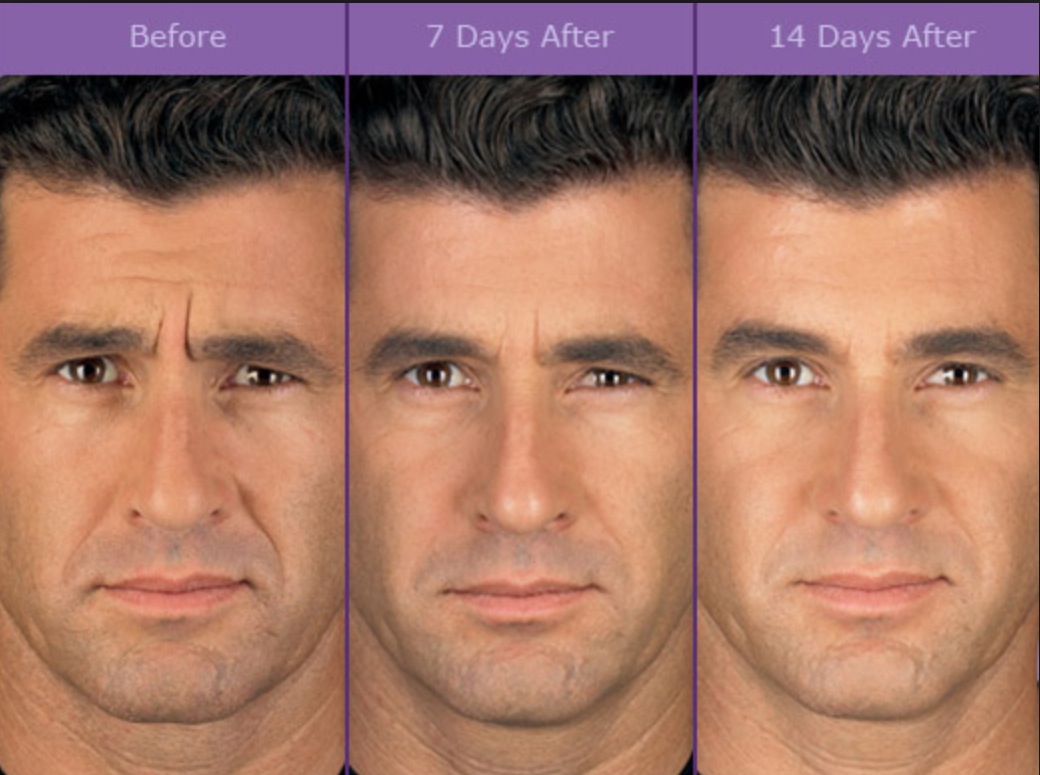 Anti Wrinkle injections for Frown Lines — Elanamie Clinic
