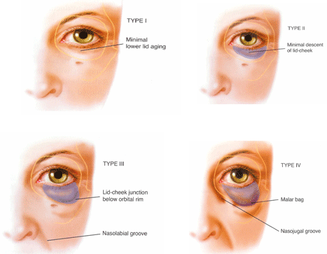 Eyes Have 3 Unique Type of Tears - Eyes On Norbeck