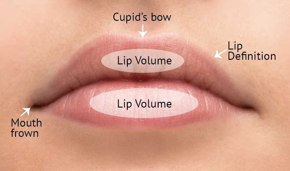Lips - Teosyal Dermal Filler Training