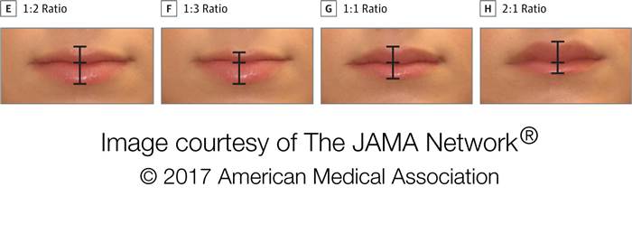 Focus groups deemed the upper to lower lip ratio of 1:2, far left, to be the most attractive on white women. The ratio of 2:1, far right, was considered least attractive.