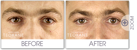 undereye teoxane.png