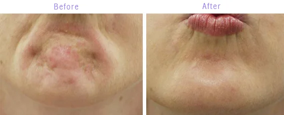 Anti Wrinkle injections for Dimpled Chin