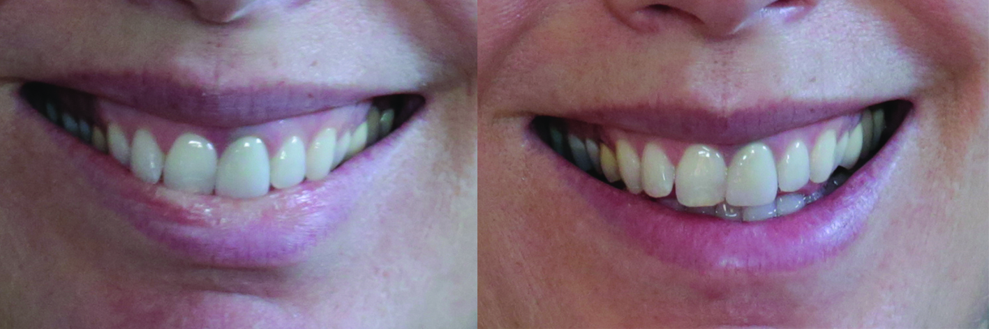 Anti Wrinkle injections for Gummy Smiles