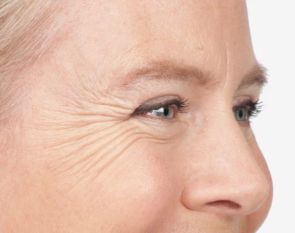 Anti Wrinkle Injections for Crow's Feet