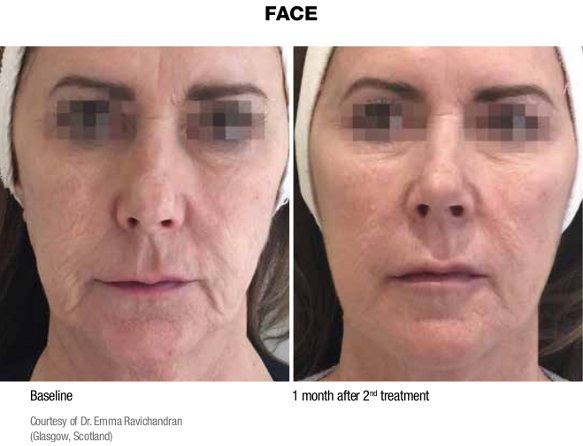 profhilo-skincare-before-and-after.jpg