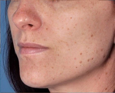 exfoliation accelerator zo