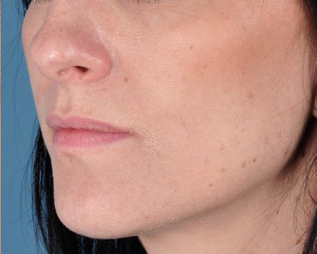 obagi zo exfoliation accelerator