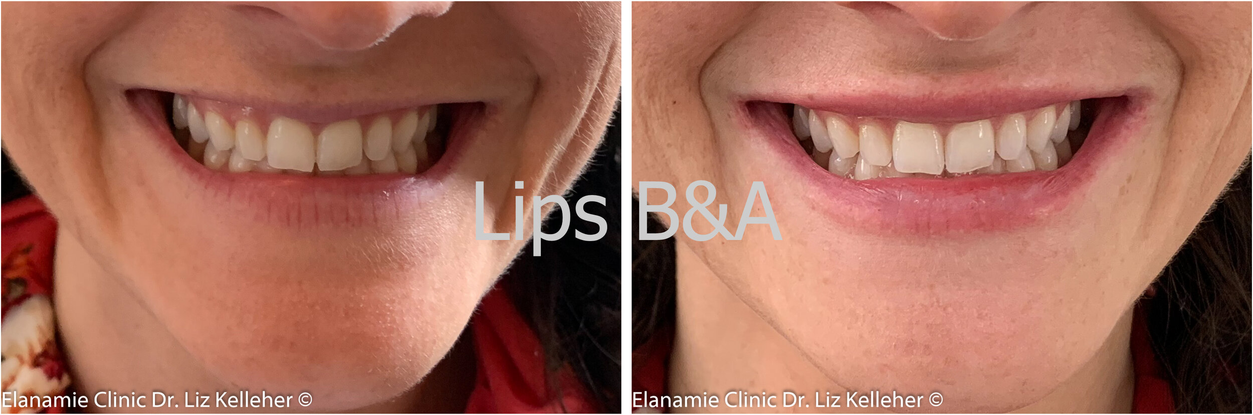 Belotero Lips Subtle