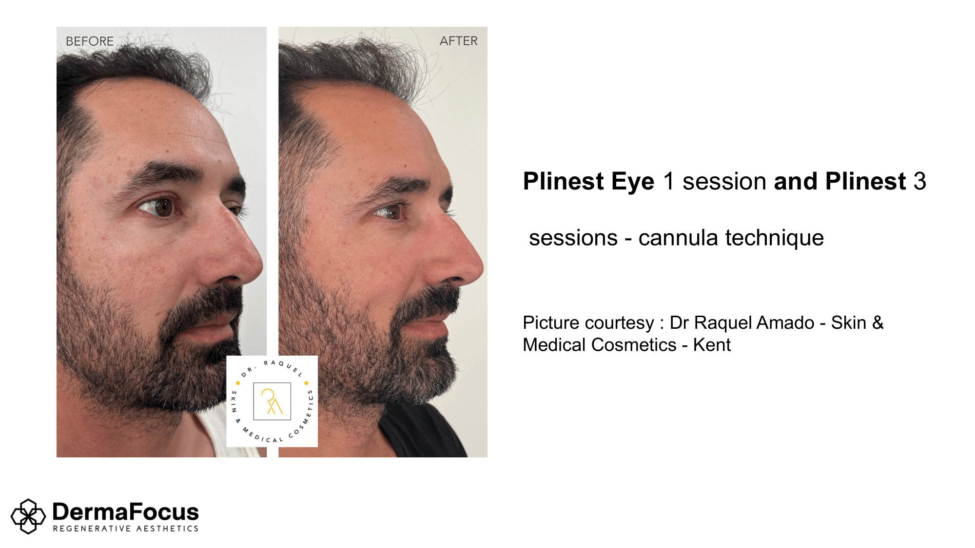 plinest eye  and plinest 3.png