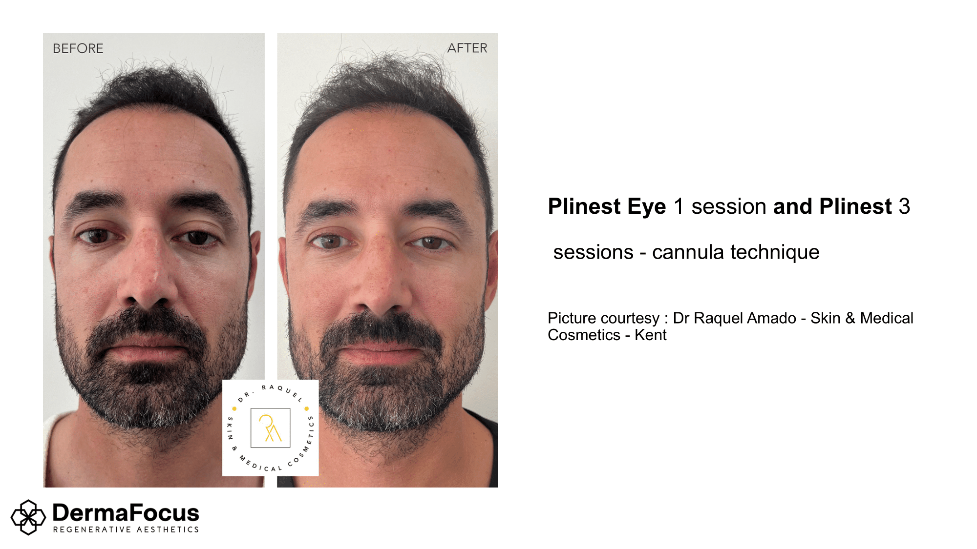 plinest eye and plinest 3 b.png