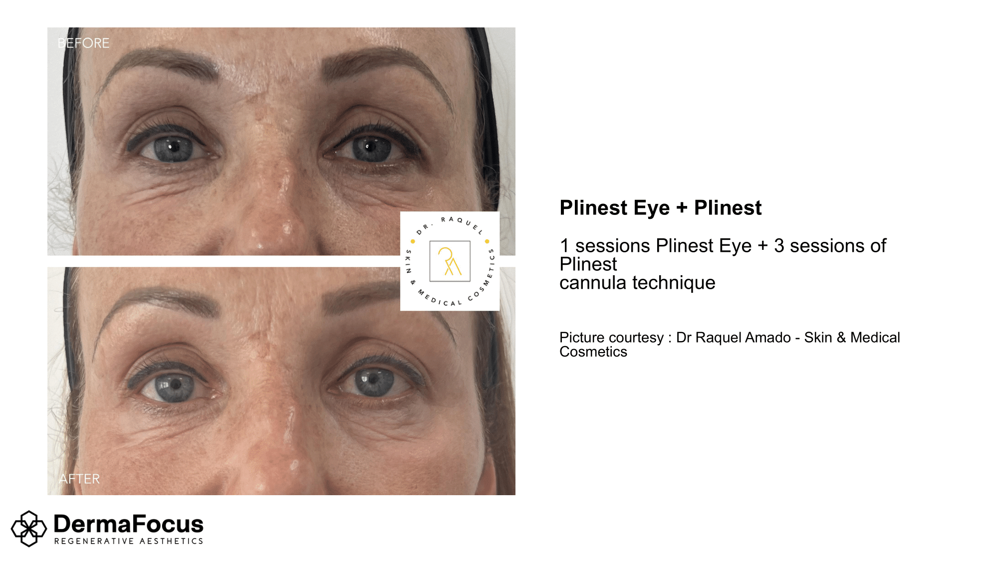 plinest eye and plinest.png