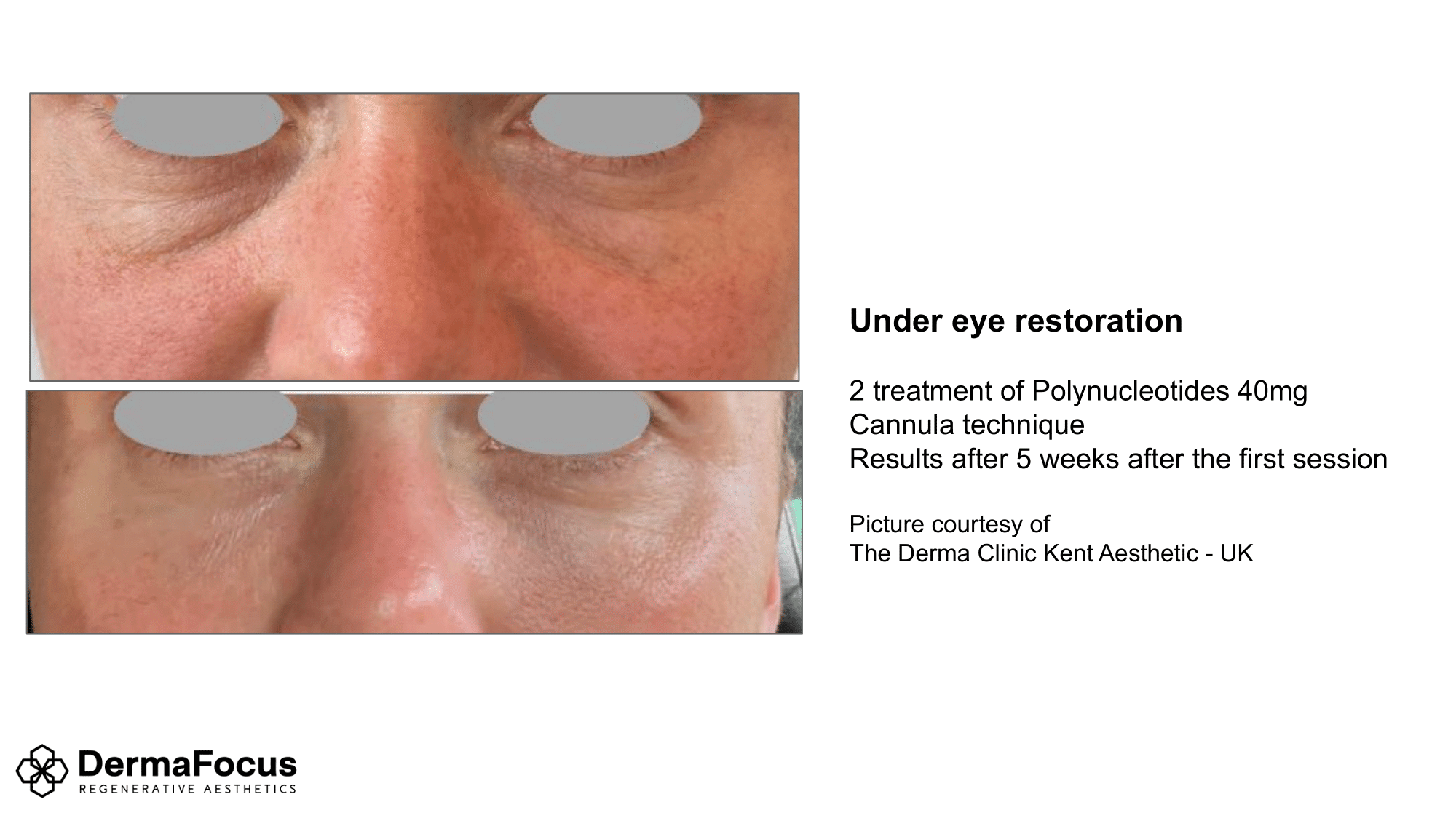 undereye restoration.png
