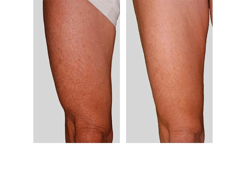 exilis-7.jpg