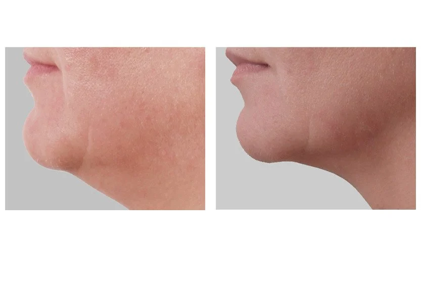 exilis-5.jpg