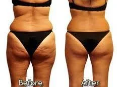 LYMPHATIC DRAINAGE BEFORE & AFTER.jpg