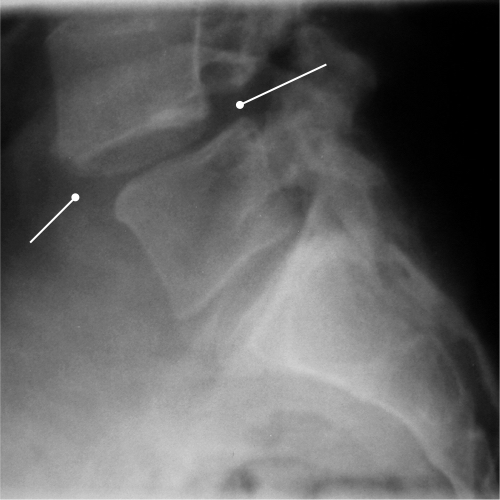 Spondylolisthesis.jpg