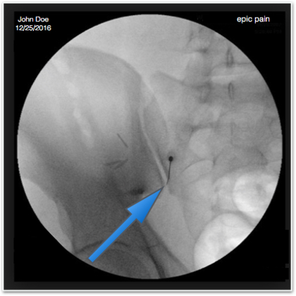 X-ray Sacroiliac Joint Injection