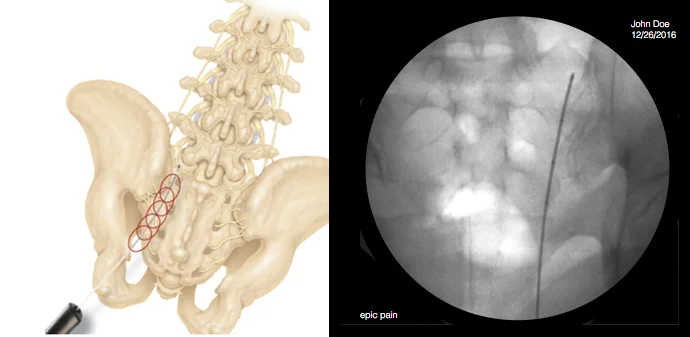 Simplicity Probe Radiofrequency Ablation of Sacroiliac Joint