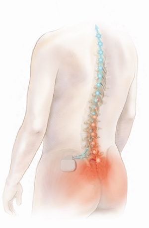 Spinal Cord Stimulator - Epic Pain Management