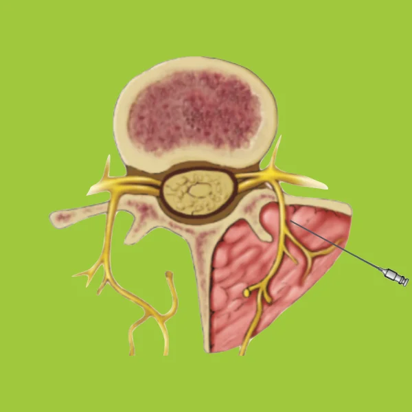 Treatment of Facet Joint Disease